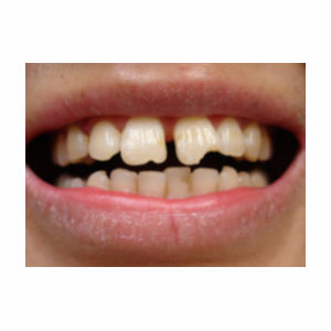 Chipped teeth treated with Dental Bonding before 3696681