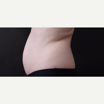 46 year old woman treated with CoolSculpting before 3168884