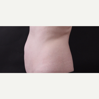 46 year old woman treated with CoolSculpting after 3168884