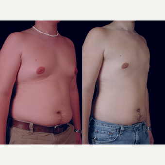 18-24 year old man treated with Male Breast Reduction before 3659098