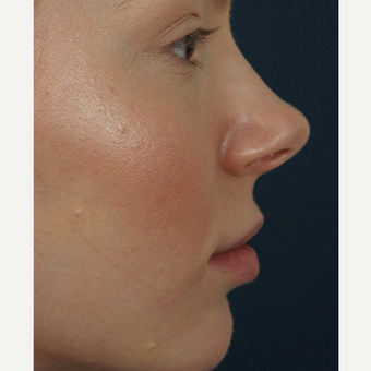 18-24 year old woman treated with Restylane Silk after 3245004
