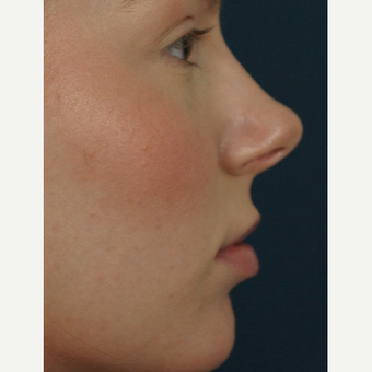 18-24 year old woman treated with Restylane Silk before 3245004