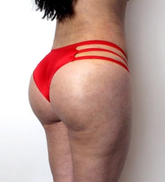 25-34 year old woman treated with Brazilian Butt Lift after 3446787