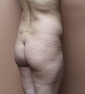 25-34 year old woman treated with Brazilian Butt Lift before 3446787