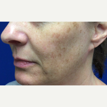 Halo Laser Treatment for this 51 Year Old Woman before 3241445