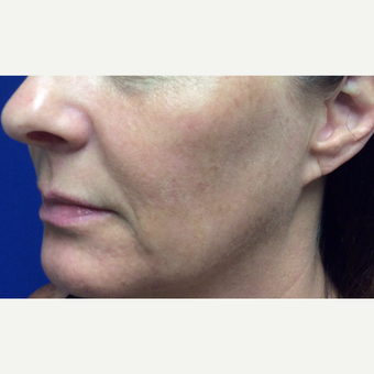 Halo Laser Treatment for this 51 Year Old Woman after 3241445