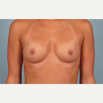 25-34 year old woman treated with Breast Augmentation before 3245260