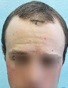 FUE – SFET Using Only Head Hair to Front and Crown Areas before 196026