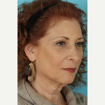 55-64 year old woman treated with Facelift before 3691353