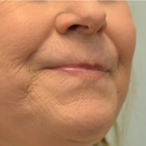 63 year old patient treated with Restylane and Juvederm for lip rejuvenation before 2272731