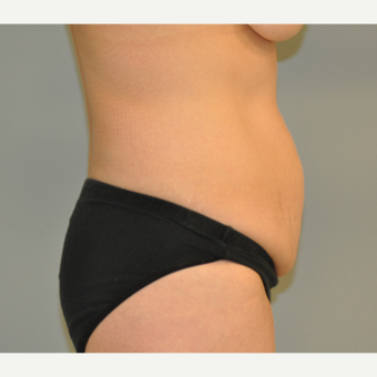 25-34 year old woman treated with Drainless Tummy Tuck and Liposuction of Flanks before 3129633