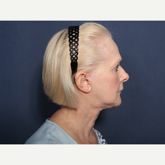 65-74 year old woman treated with Neck Lift (view 2 of 2) after 3259227