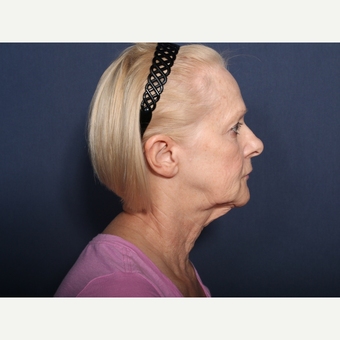 65-74 year old woman treated with Neck Lift (view 2 of 2) before 3259227