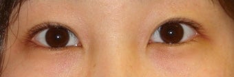 Bilateral Asian Eyelid Surgery after 861149