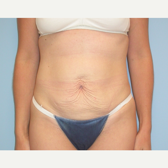 38 year old woman treated with Tummy Tuck before 3220177