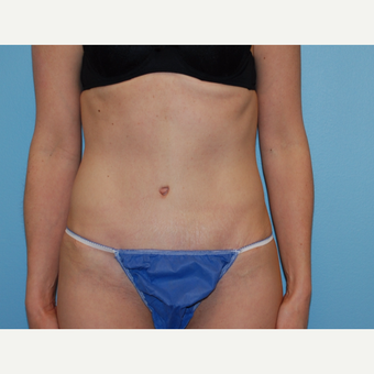 38 year old woman treated with Tummy Tuck after 3220177