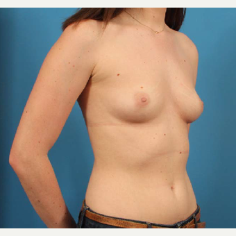 18-24 year old woman treated with Anatomically Shaped Breast Implants before 3244574