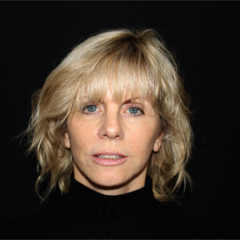 55-64 year old woman treated with Facelift after 3498818