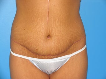 28 yr old woman with body lift after 1038463
