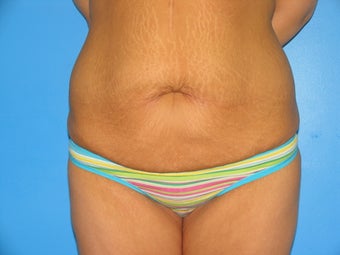 28 yr old woman with body lift before 1038463