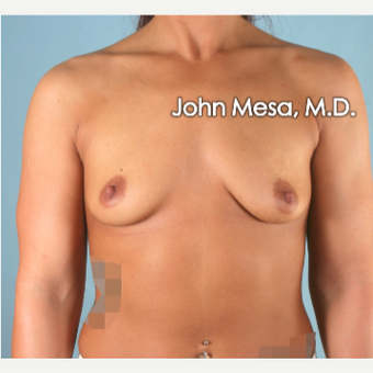 18-24 year old woman treated with Breast Augmentation before 3266886