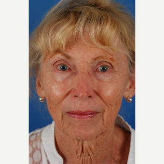 76 year old woman with thin skin treated with Endoscopic Facelift before 3662885