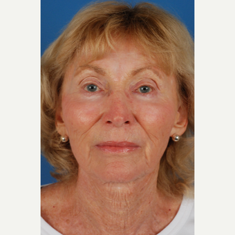 76 year old woman with thin skin treated with Endoscopic Facelift after 3662885