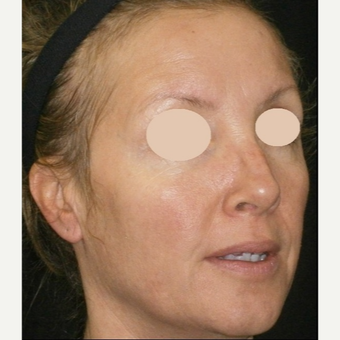 35-44 year old woman treated with IPL after 3122396