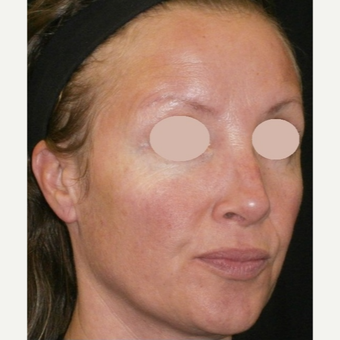 35-44 year old woman treated with IPL before 3122396