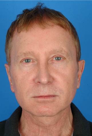 61 year old male treated with Ultherapy for his neck and brows. before 1174007