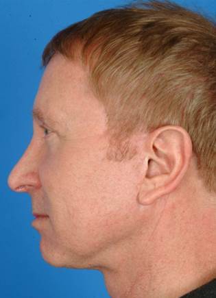61 year old male treated with Ultherapy for his neck and brows. 1174007