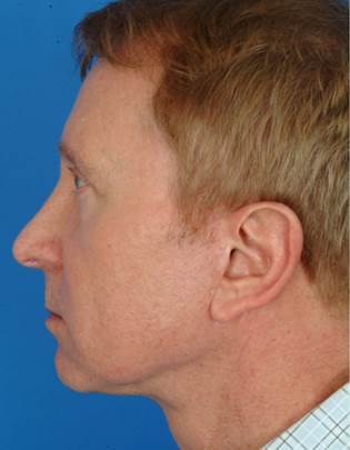 61 year old male treated with Ultherapy for his neck and brows. 1174007