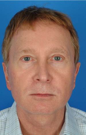 61 year old male treated with Ultherapy for his neck and brows. after 1174007