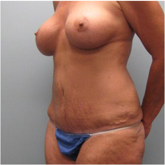 56 year old woman treated with Mommy Makeover after 3680003