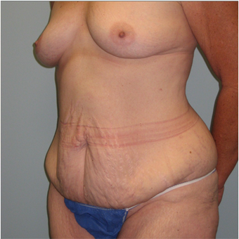 56 year old woman treated with Mommy Makeover before 3680003
