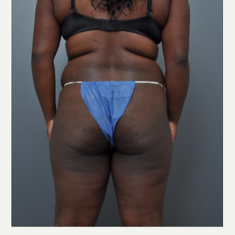35-44 year old woman treated with Liposuction before 3460145