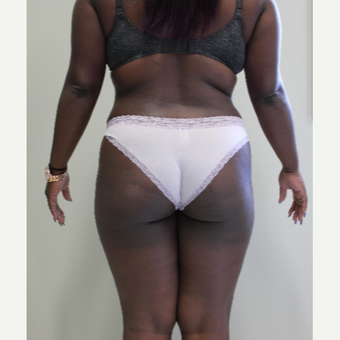 35-44 year old woman treated with Liposuction after 3460145