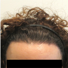 35-44 year old woman treated with Hair Transplant after 1830615
