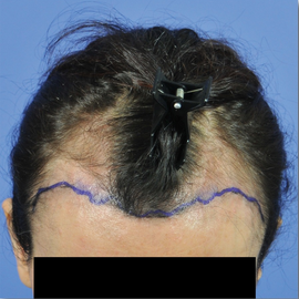 35-44 year old woman treated with Hair Transplant before 1830615