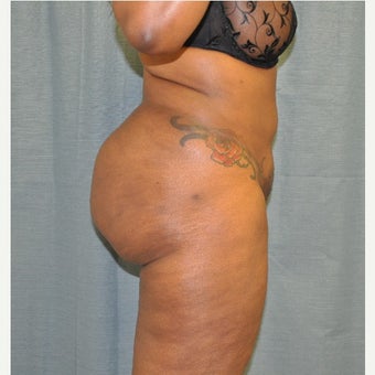 35-44 year old woman treated with Brazilian Butt Lift after 1667275