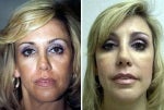 48 year old lady before and after cheek augmentation before 735715