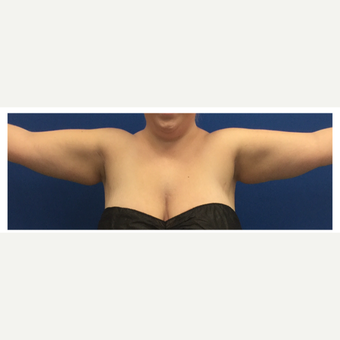 18-24 year old woman treated with Laser Liposuction of the arms before 3495539