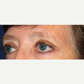 55-64 year old woman treated with Eyelid Surgery after 3776269