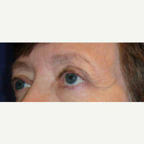 55-64 year old woman treated with Eyelid Surgery before 3776269
