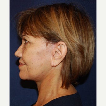 65-74 year old woman treated with Mini Lift after 2672141