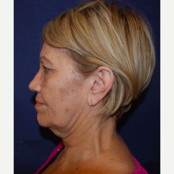 65-74 year old woman treated with Mini Lift before 2672141