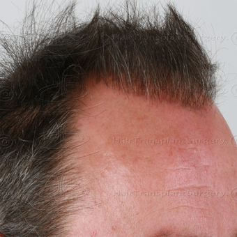 Dr Devroye - HTS Clinic - 3749 FUT - Result after 1 year post-op before 3021389