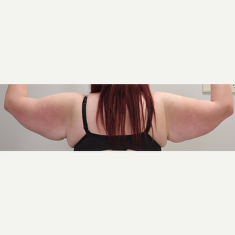 18-24 year old woman treated with Arm Lift before 3065889