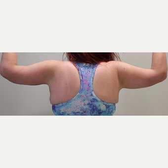18-24 year old woman treated with Arm Lift after 3065889