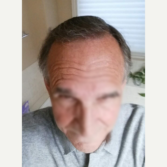 65-74 year old man treated with ARTAS Robotic Hair Transplant after 3066755